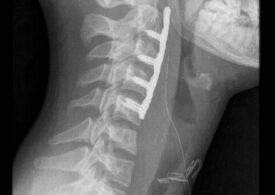 Ortopeda ostrzega - skoki na główkę grożą kalectwem